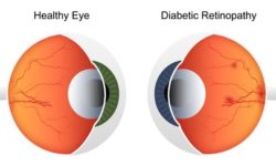 Illustration of hemorrhage in retina - Diabetic Retinopathy