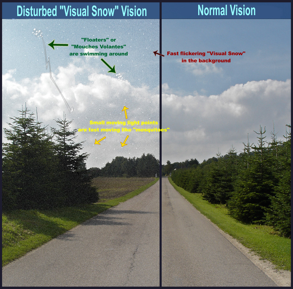 retinal detachment vision